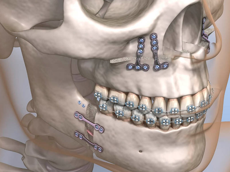 cirurgia bucomaxilofacial