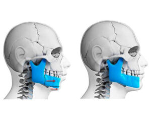 cirurgia bucomaxilofacial