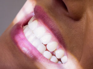 clareamento dental