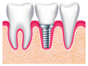 implantes dentários