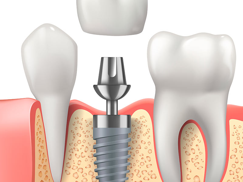 implantes dentários