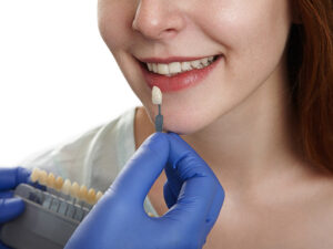 lentes de contato dental