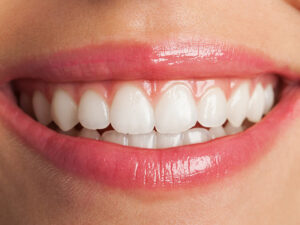 lentes de contato dental